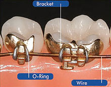 ibraces diagram